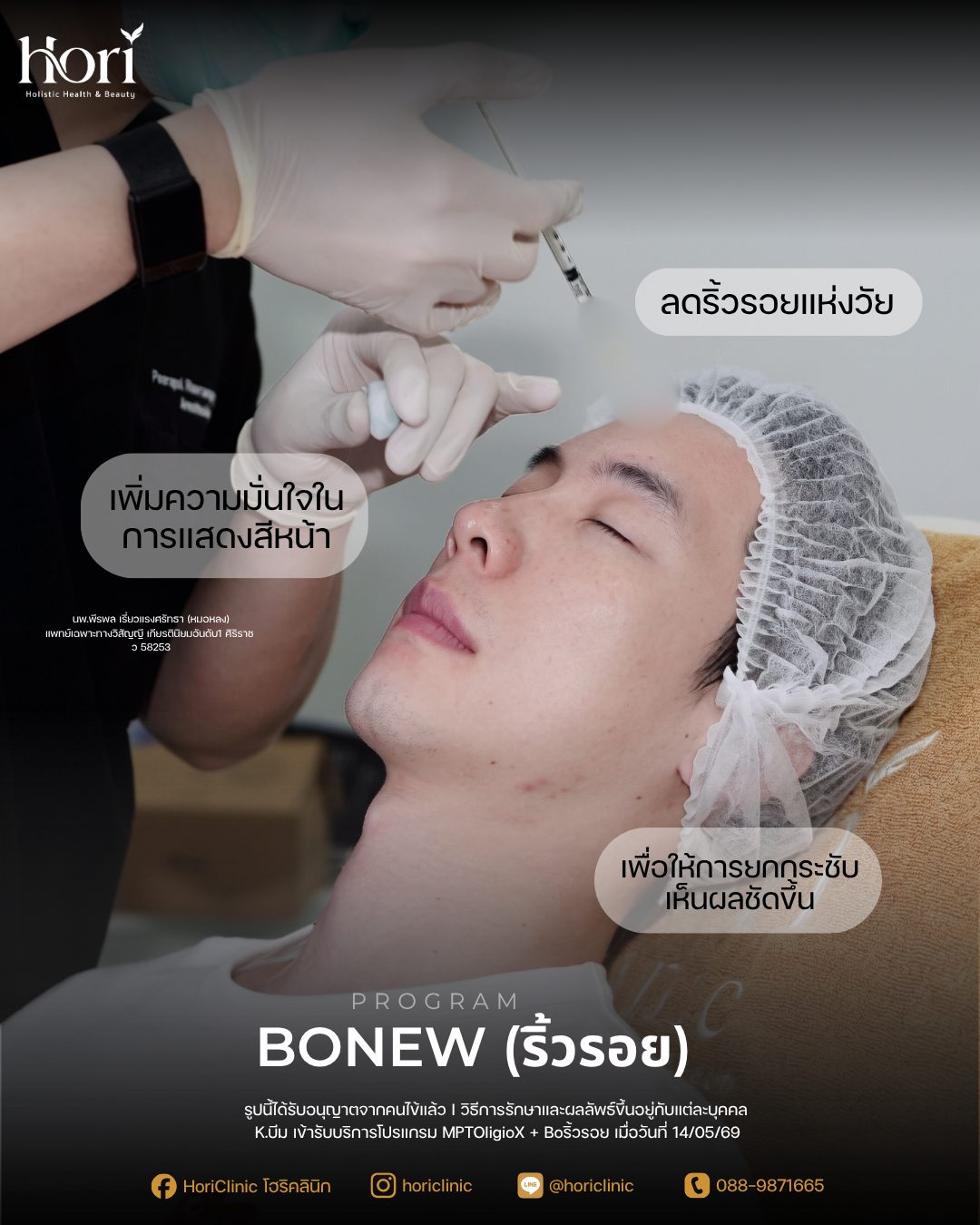 รีวิวโปรแกรม Bonew โบท็อกซ์ริ้วรอย — เคส K.บีม | Hori Clinic