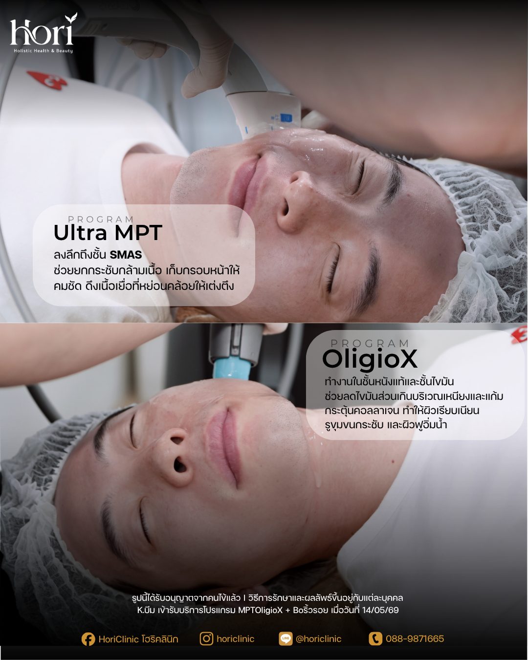 ขั้นตอนโปรแกรม MPTOligioX — Ultra MPT และ OligioX — เคส K.บีม | Hori Clinic