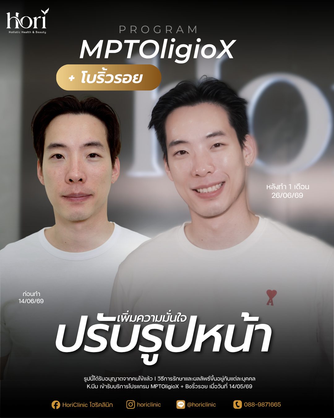 รีวิว MPTOligioX + โบริ้วรอย — K.บีม | Hori Clinic