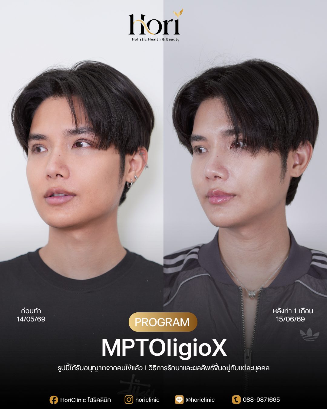 รีวิว MPTOligioX — K.ท็อป ก่อนทำและหลังทำ 1 เดือน มุมเฉียง | Hori Clinic