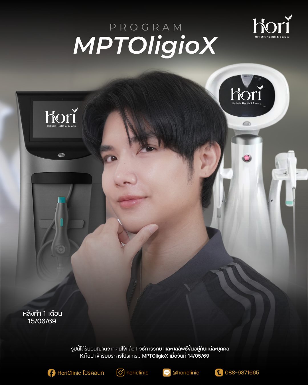 รีวิว MPTOligioX (Ultraformer MPT + Oligio X) — K.ท็อป หลังทำ 1 เดือน | Hori Clinic