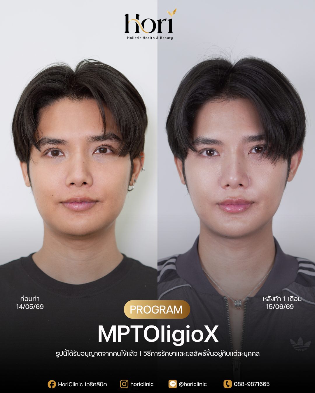 รีวิว MPTOligioX — K.ท็อป | Hori Clinic