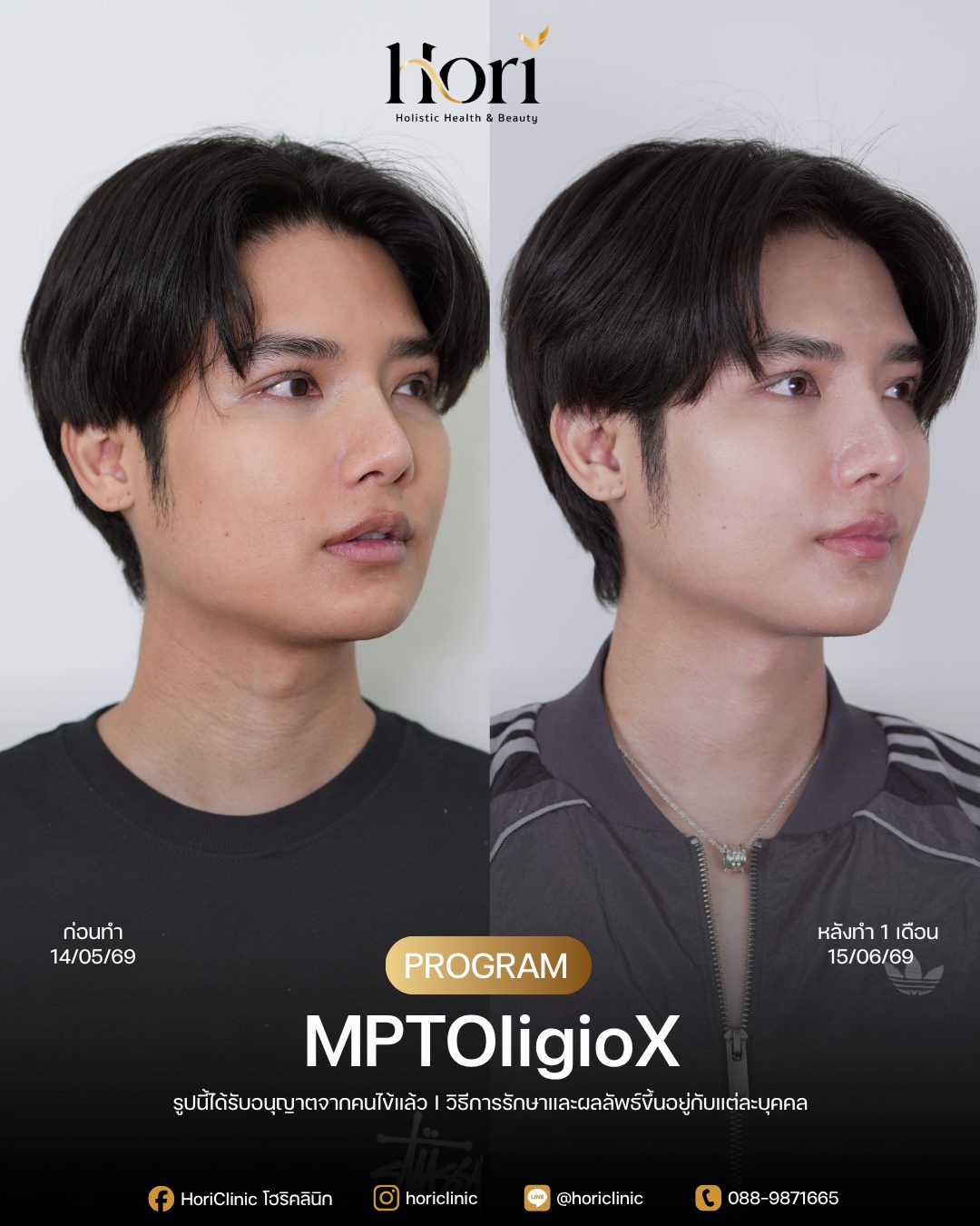 รีวิว MPTOligioX — K.ท็อป ก่อนทำและหลังทำ 1 เดือน ด้านข้าง | Hori Clinic