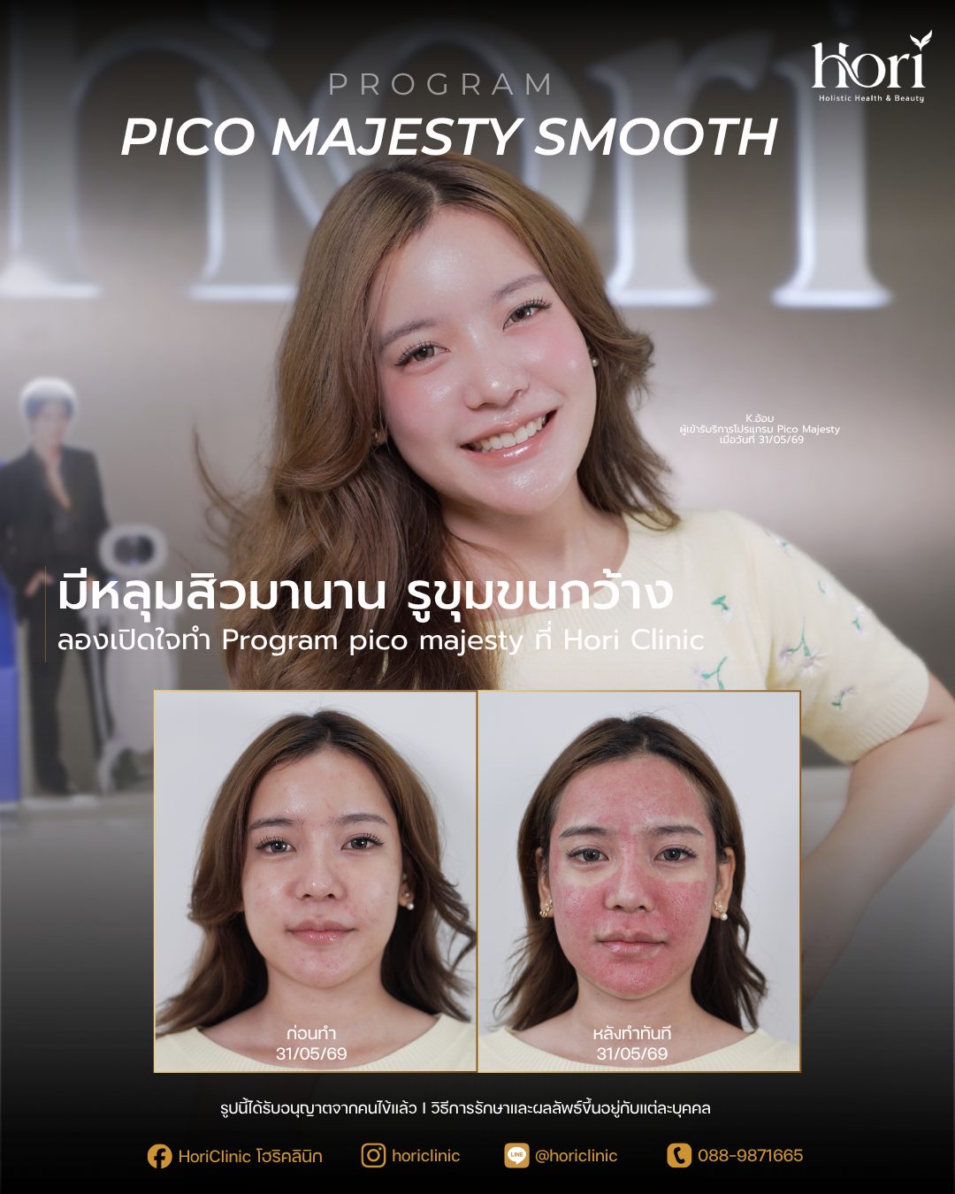 รีวิว Pico Majesty Smooth — K.อ้อม | Hori Clinic