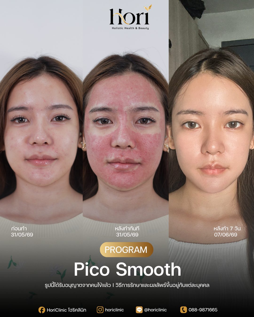 รีวิว Pico Smooth — K.อ้อม ก่อนทำและหลังทำ 7 วัน | Hori Clinic