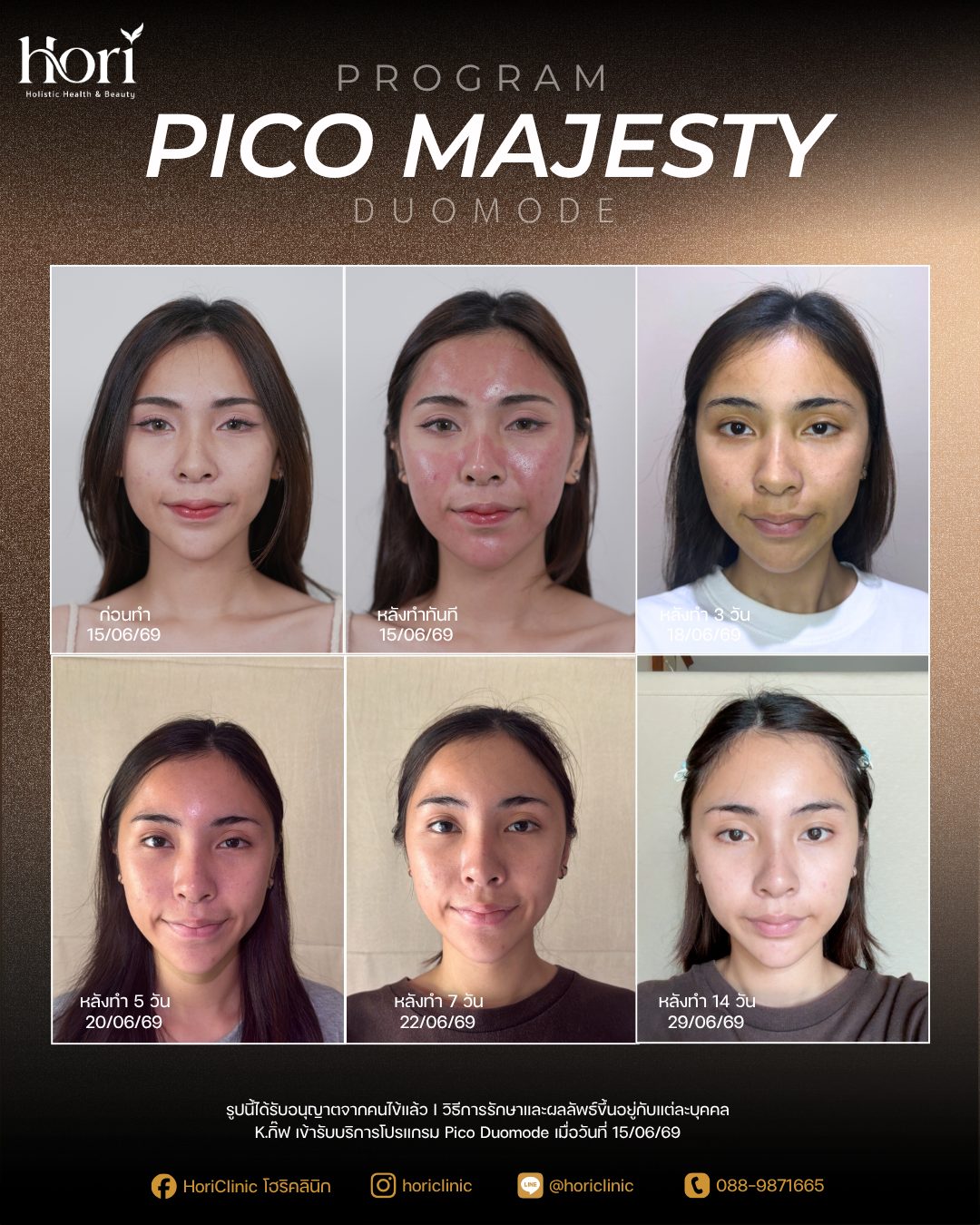 รีวิว Pico Majesty Duomode — K.กิ๊ฟ | Hori Clinic