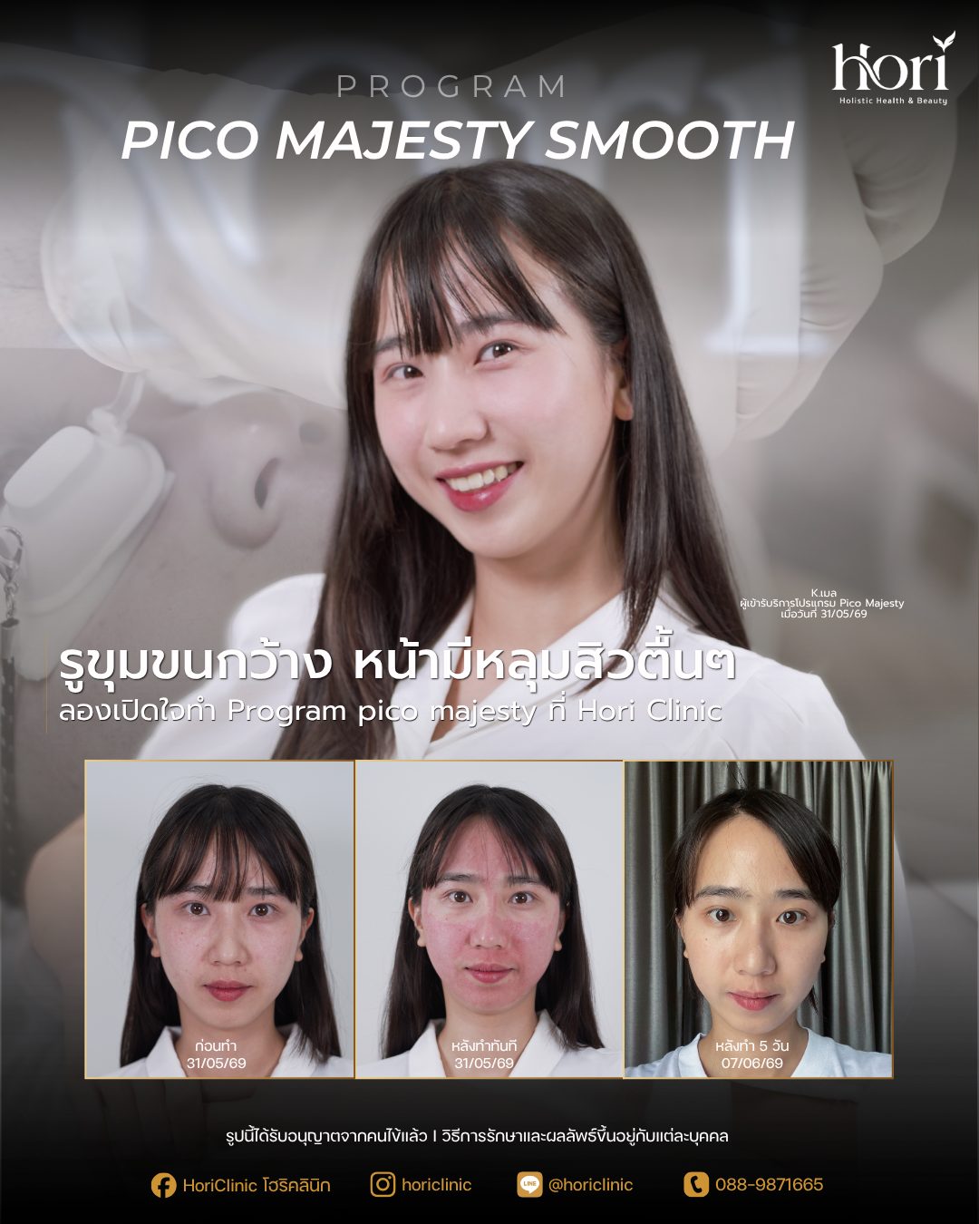 รีวิว Pico Majesty Smooth — K.เมล | Hori Clinic