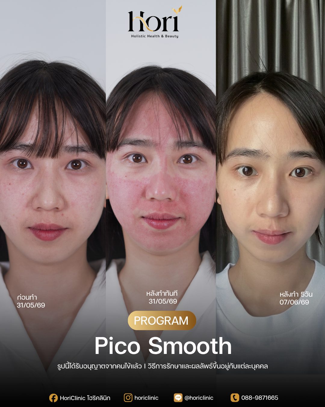 รีวิว Pico Smooth — K.เมล ก่อนทำและหลังทำ 5 วัน | Hori Clinic