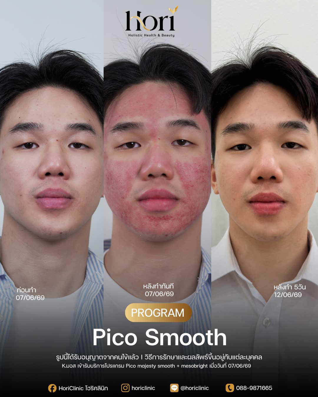 รีวิว Pico Smooth — K.มอส | Hori Clinic