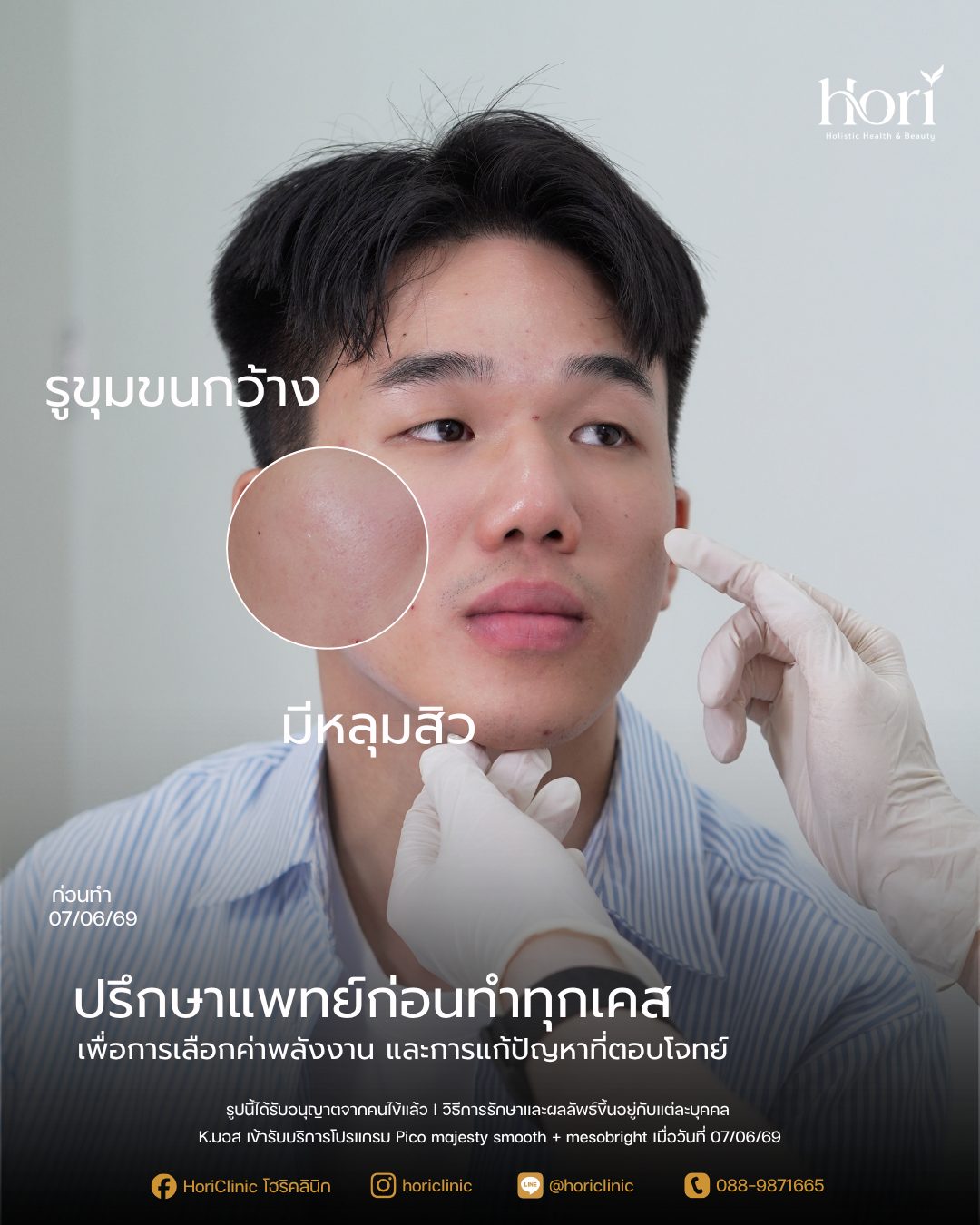 ประเมินผิวก่อนทำ Pico — รูขุมขนกว้าง หลุมสิว — เคส K.มอส | Hori Clinic