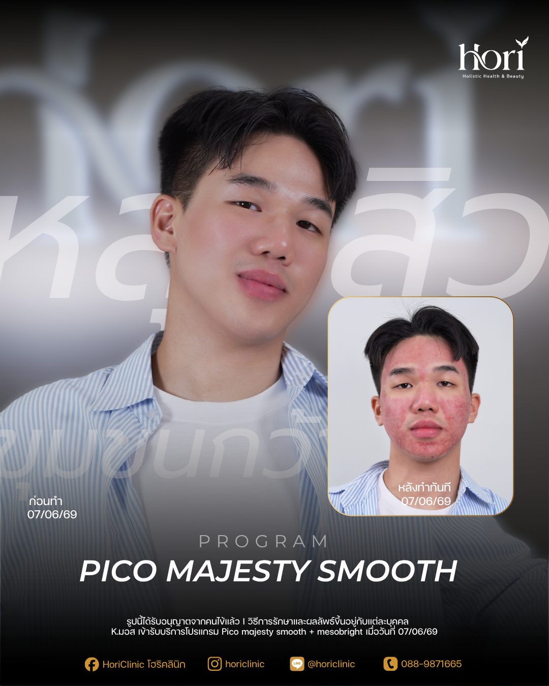 รีวิว Pico Majesty Smooth + Mesobright — K.มอส | Hori Clinic
