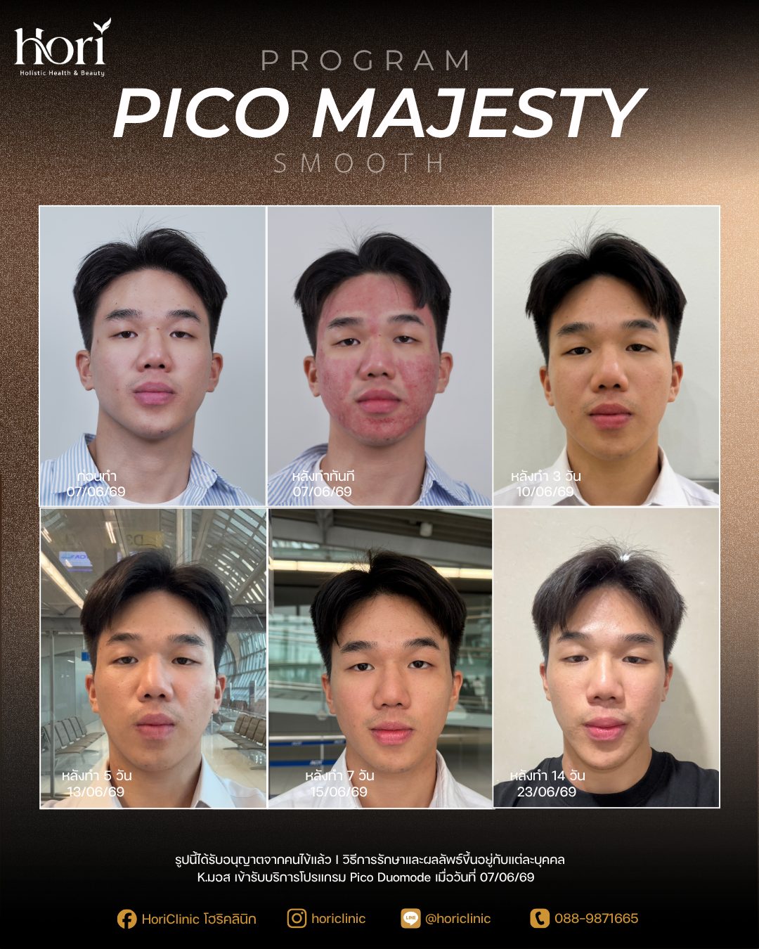 รีวิว Pico Majesty Smooth — K.มอส ก่อนทำถึงหลังทำ 14 วัน | Hori Clinic