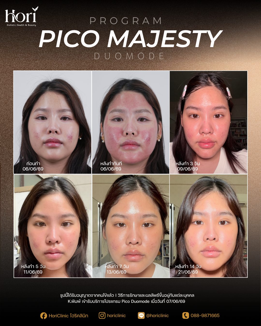 รีวิว Pico Majesty Duomode — K.พิมพ์ ก่อนทำถึงหลังทำ 14 วัน | Hori Clinic
