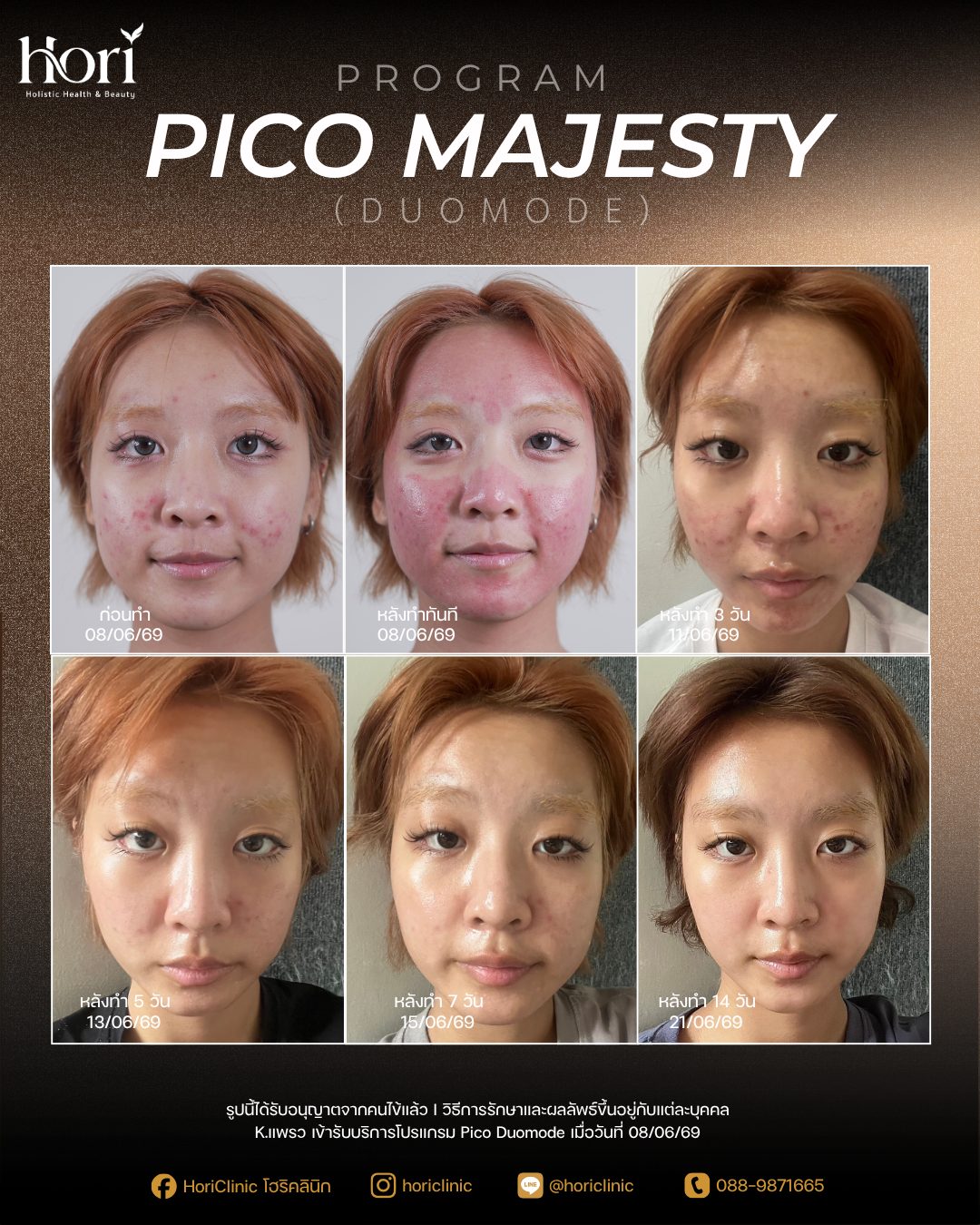 รีวิว Pico Majesty Duomode — K.แพรว ก่อนทำถึงหลังทำ 14 วัน | Hori Clinic