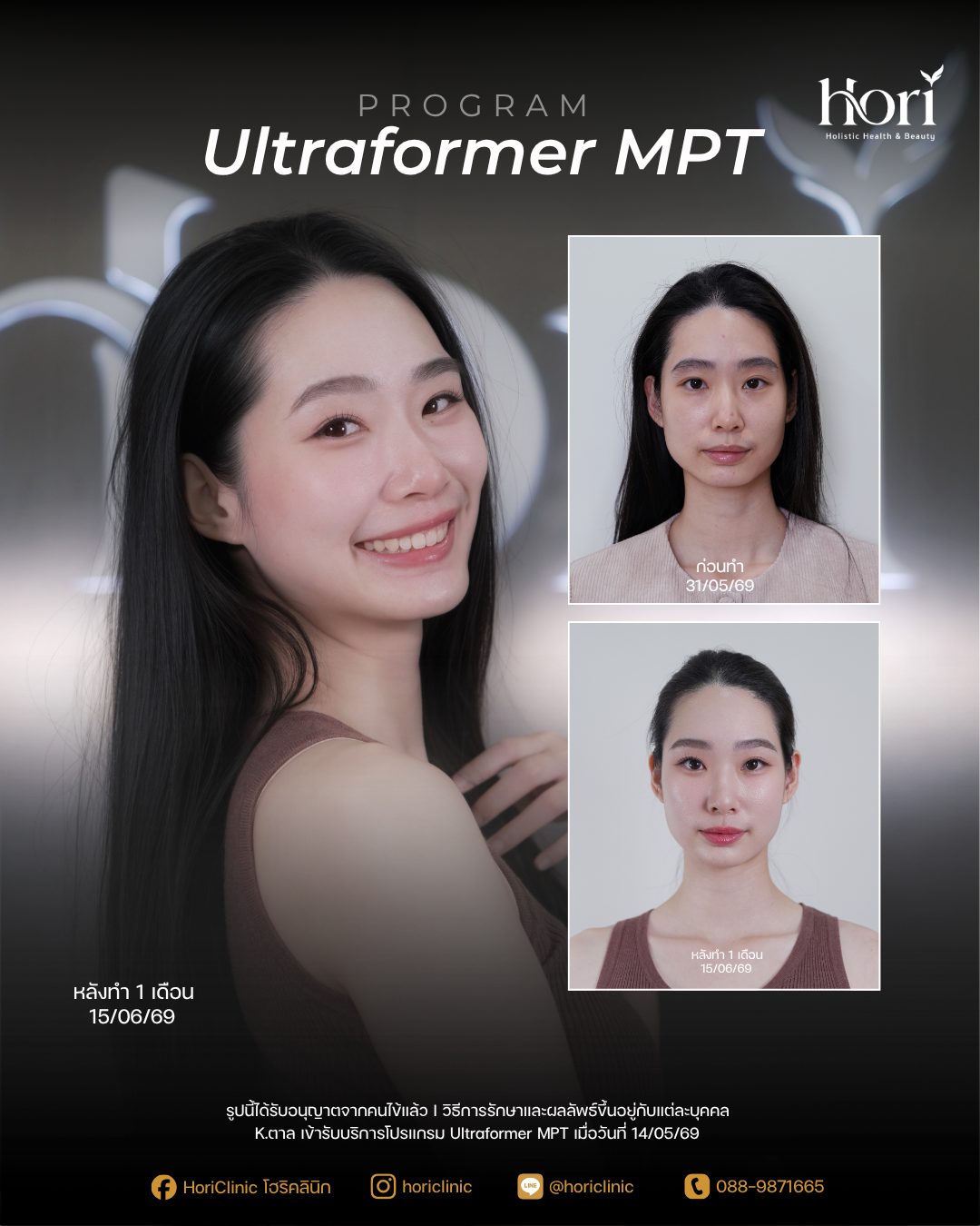 รีวิว Ultraformer MPT — K.ตาล | Hori Clinic